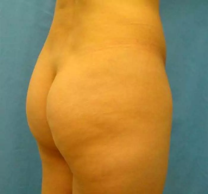 chirurgie-esthetique-fesses-plastie-fesse-dr-guzman-05