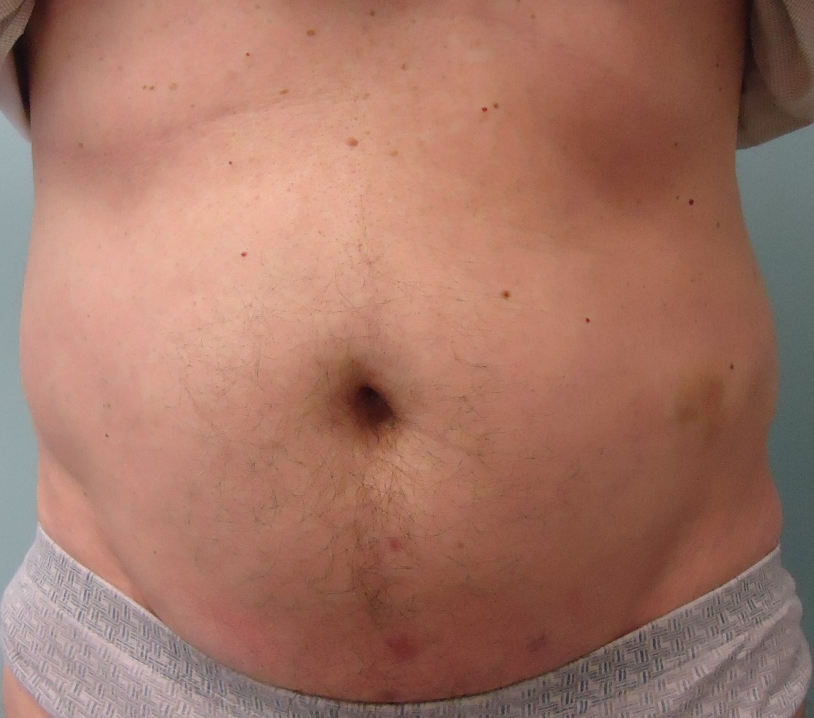 Avant traitement amas graisseux Dr Guzman Chirurgien Esthétique à Paris 7