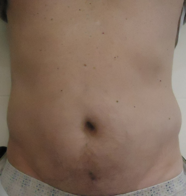 Après traitement graisse ventre Dr Guzman Chirurgien Esthétique à Paris 7