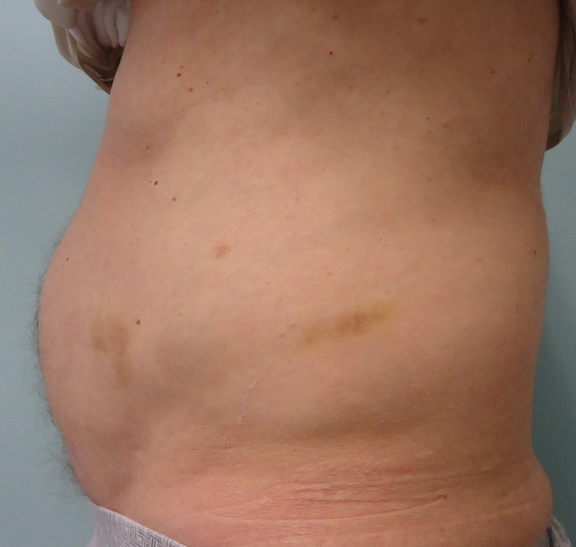 Avant traitement graisse ventre Dr Guzman Chirurgien Esthétique à Paris 7