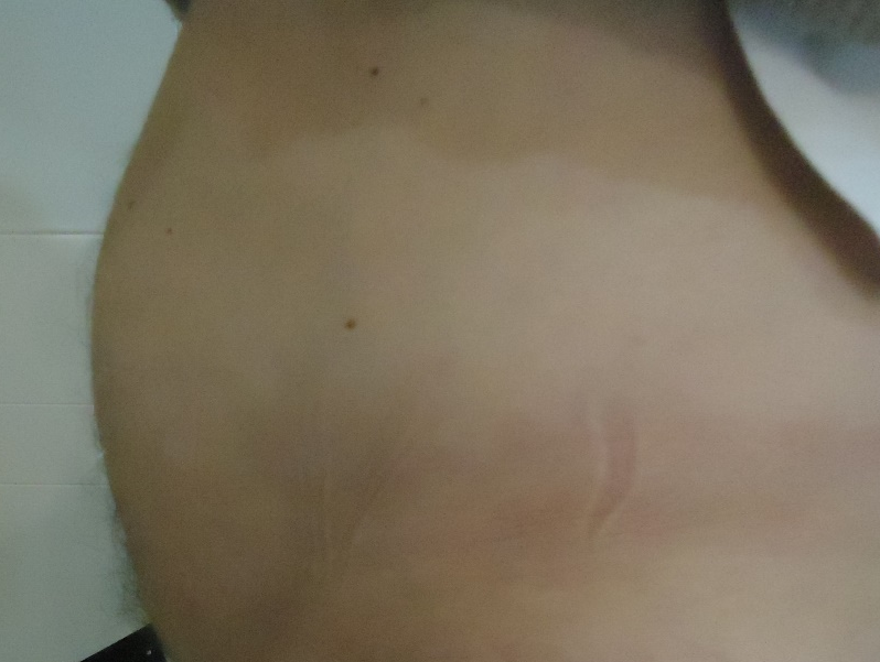 Après traitement amas graisseux Dr Guzman Chirurgien Esthétique à Paris 7