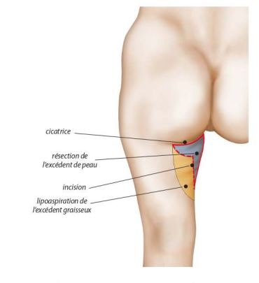 Lifting des cuisses Dr Guzman Chirurgien Esthétique à Paris 7