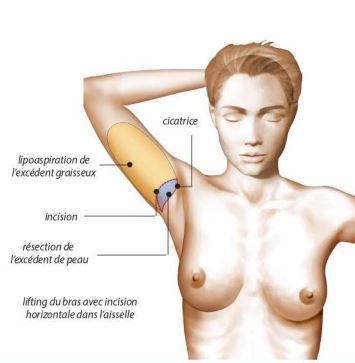 Lifting des bras Dr Guzman Chirurgien Esthétique à Paris 7